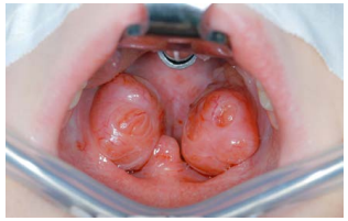 HTML view of the file Tonsillotomy partial and complete